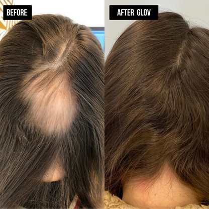 Glov Hair Regrowth System